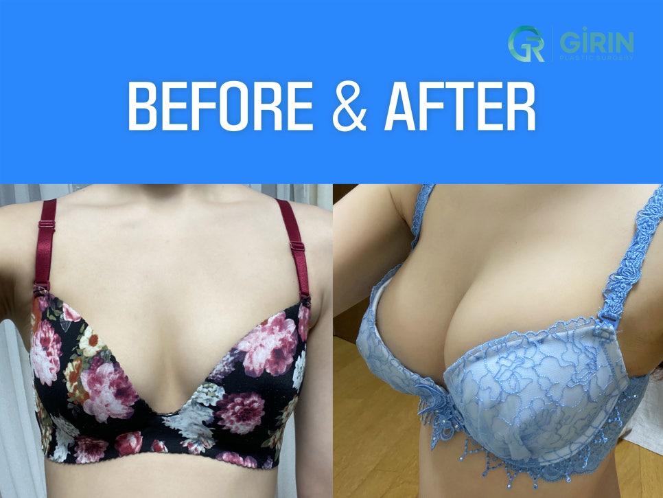 유방확대술 고려하고 있다면 관련 이미지 10