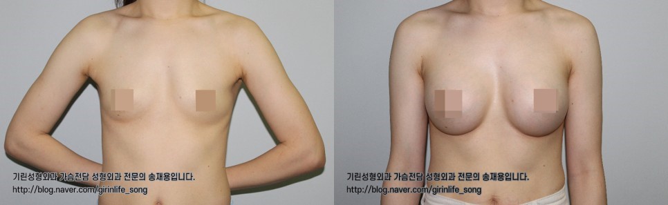 [가슴확대성형] 75A에서 75C로, 모티바 보형물을 이용한 가슴 확대 수술 케이스 관련 이미지 14