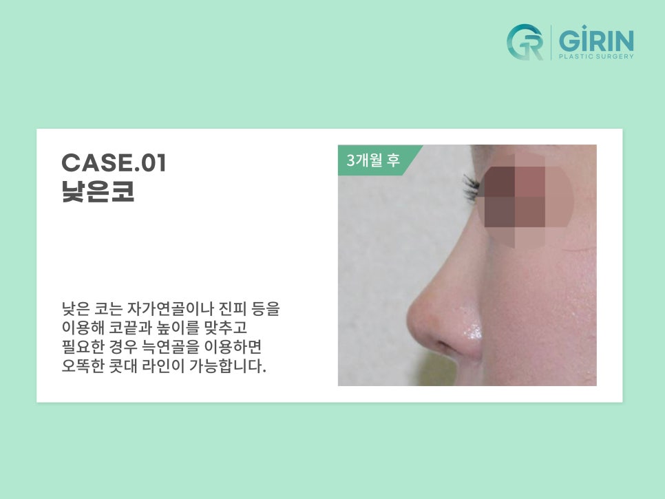 코성형 종류 비교하고 맞춰서 관련 이미지 7