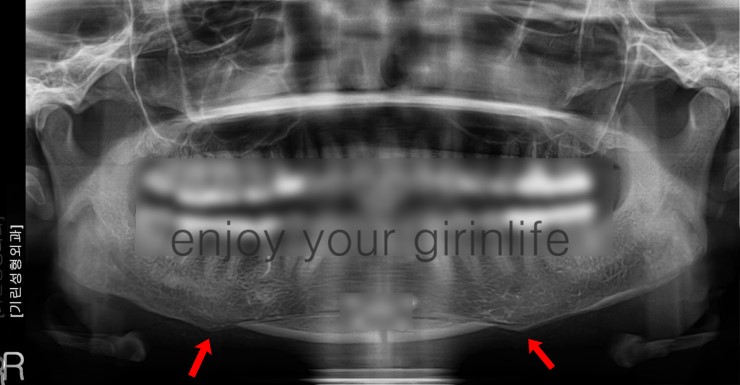 사각턱재수술 -계단현상 관련 이미지 1