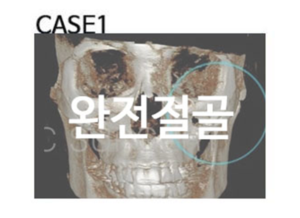 광대뼈축소술, 개인마다 다른 케이스는? 관련 이미지 1
