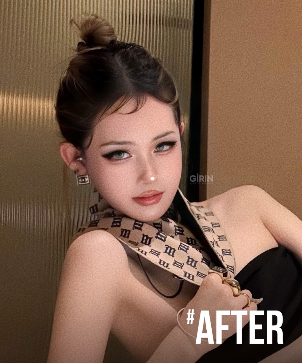 기린 성형외과는 광대축소술을 어떻게 진행하나요? 관련 이미지 5