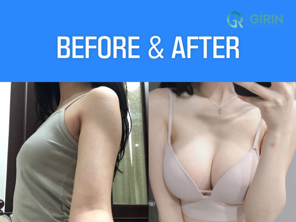 유방확대술 고려하고 있다면 관련 이미지 2