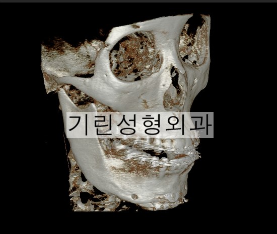 효과없는 브이라인수술 (수술 후 U라인) 관련 이미지 1