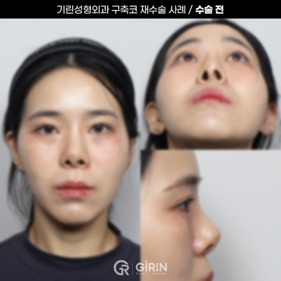 기린성형외과 코성형 구축코 재건 사례 관련 이미지 2