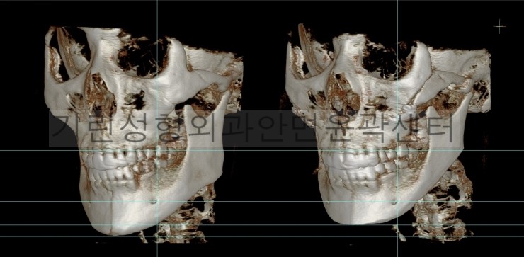 긴곡선 앞턱길이줄임+광대고정 관련 이미지 6