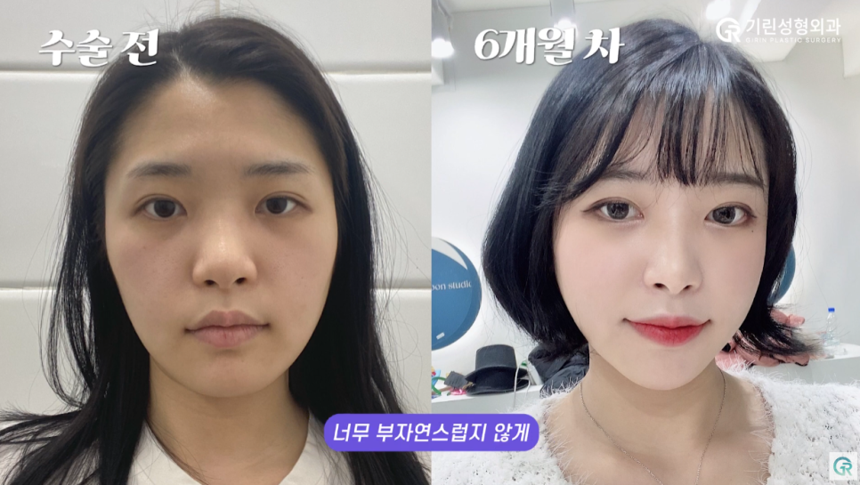 [기린성형외과의원] ❌보정어플은 당장 삭제❌_윤곽3종 수술일지 관련 이미지 13