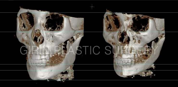 비대칭교정, 긴턱교정 22일경과 관련 이미지 4