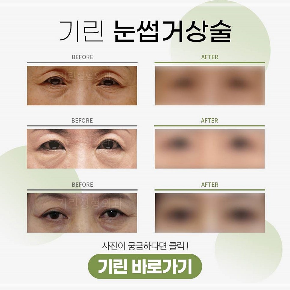 처진눈 눈썹하거상술 세월을 비켜갈 눈썹리프팅 효과란? 관련 이미지 10