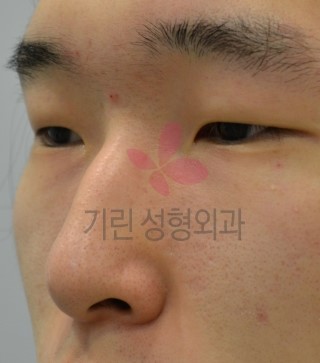 매부리코성형 : (남자코성형 전후 - 수술후 7일) 관련 이미지 1