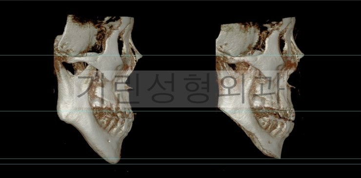 뉴브이라인 긴턱축소 사례 관련 이미지 5