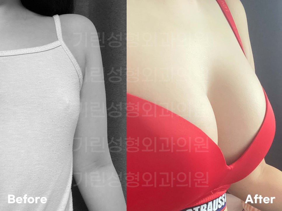 멘토가슴성형 차이를 알고 선택해야 관련 이미지 3