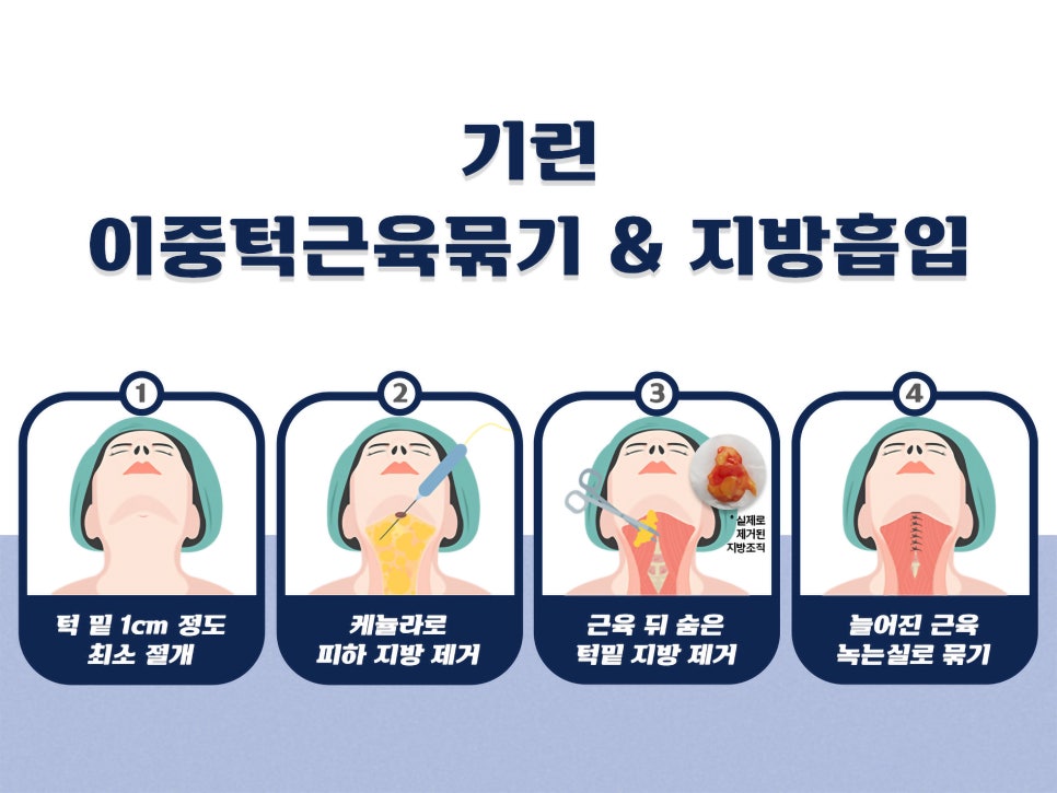 이중턱지흡 생각한다면 관련 이미지 6