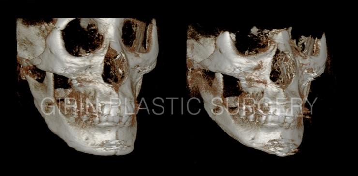 티절골재수술사례 관련 이미지 2