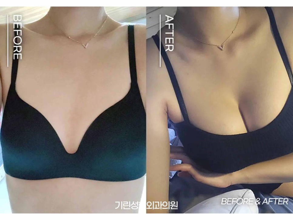 멘토가슴성형 다른 점이 무엇일까? 관련 이미지 9