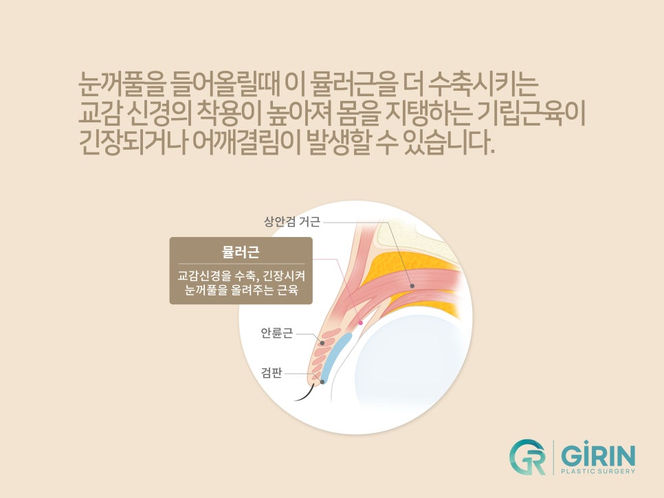 처진눈성형 다시 눈매를 잡아주며 관련 이미지 6