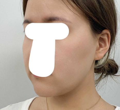 연조직윤곽술 후기, 볼살보다 신경 쓰였던 턱선 변화 관련 이미지 4