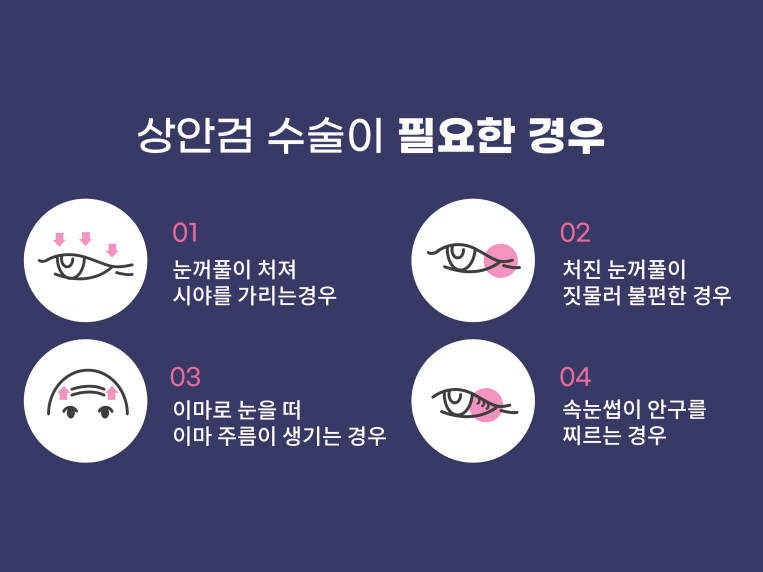 상하안검수술 인상을 바꾸기 위해 관련 이미지 7