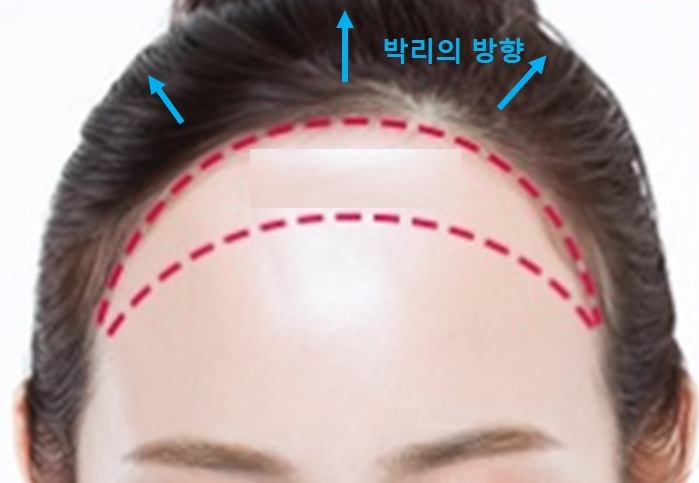 [공유] 이마축소술! 어떤 과정으로 수술하는지 알려드립니다 (안심하세요!) <<수술과정 大해부>> 관련 이미지 8