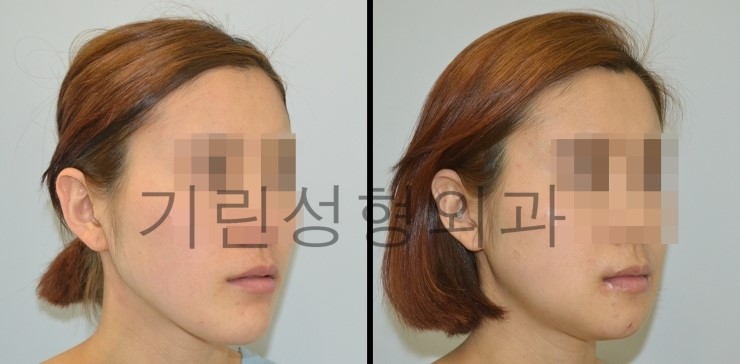 사각턱재수술 길이줄임 7일경과사진 관련 이미지 3