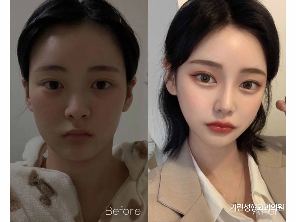 여자코성형 원하는 라인 고려하여 관련 이미지 12