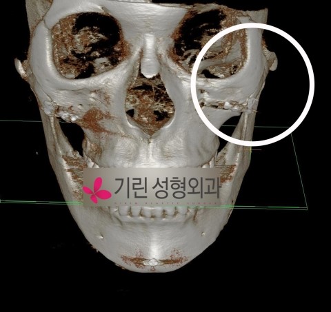 옆광대축소 전후CT 관련 이미지 4