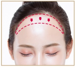 [공유] 이마축소술 두피탄력도 측정? 정말 그렇게 하는게 맞아요? 저는 몇 센티를 줄일 수 있나요? 관련 이미지 1