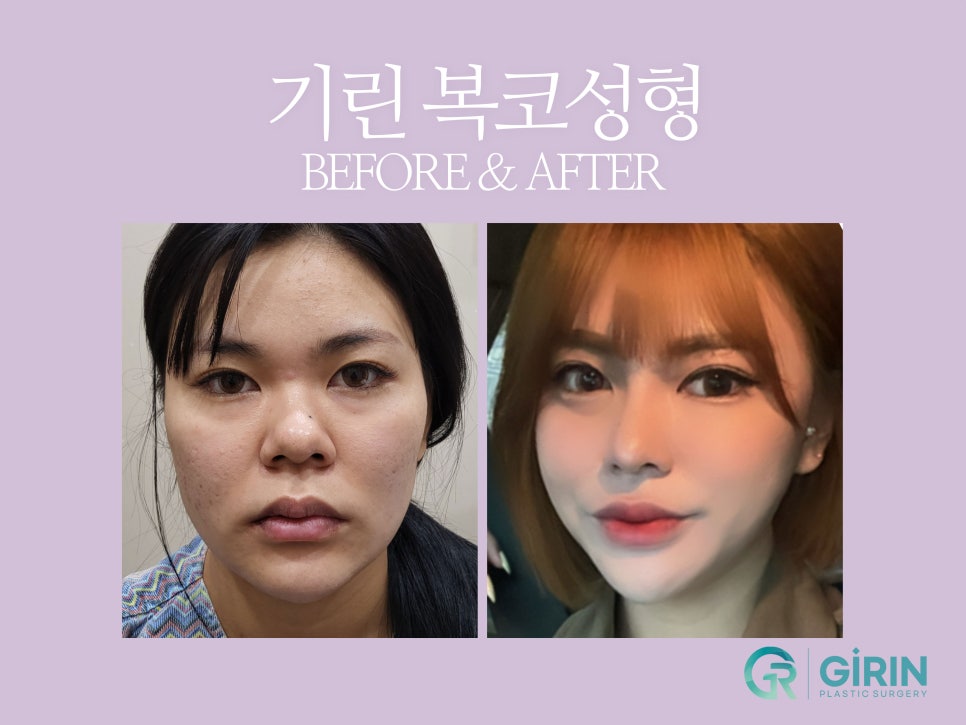 복코성형후기 세련미 있는 코 원한다면 관련 이미지 3