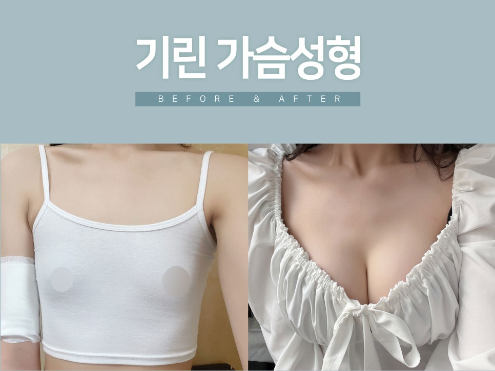 가슴성형 촉감도 중요하니까 관련 이미지 5