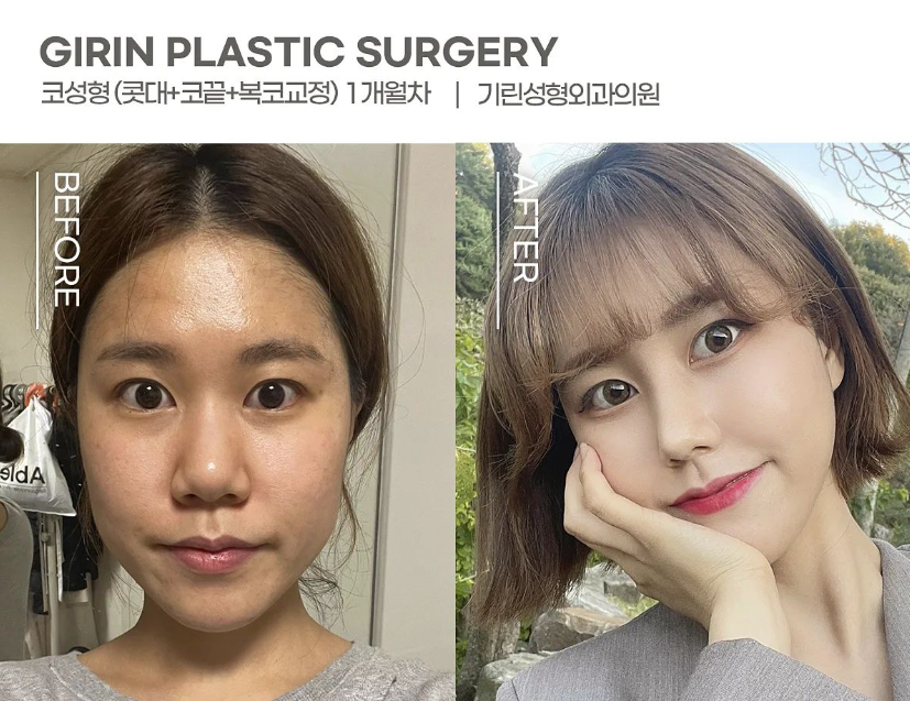 코성형 종류 비교하고 맞춰서 관련 이미지 12