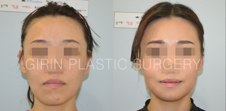 비대칭교정, 긴턱교정 22일경과 관련 이미지 1