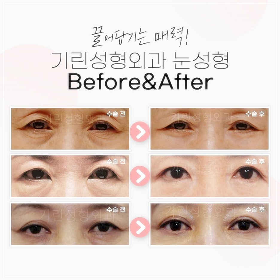 안검하수수술 눈꺼풀처짐 개선이 먼저입니다! 관련 이미지 7