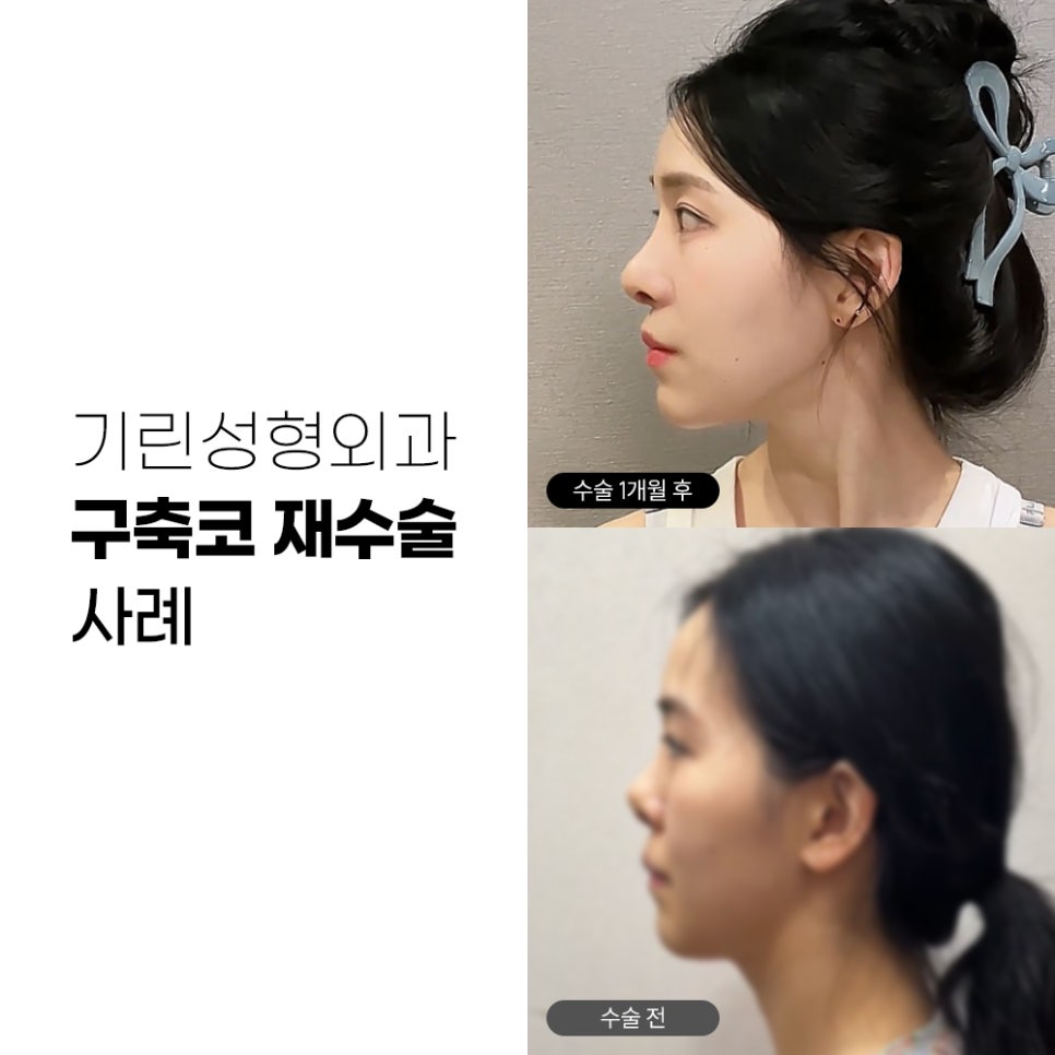 기린성형외과 코성형 구축코 재건 사례 관련 이미지 1