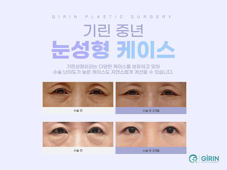 하안검수술잘하는곳 주름이 고민이라면 관련 이미지 10