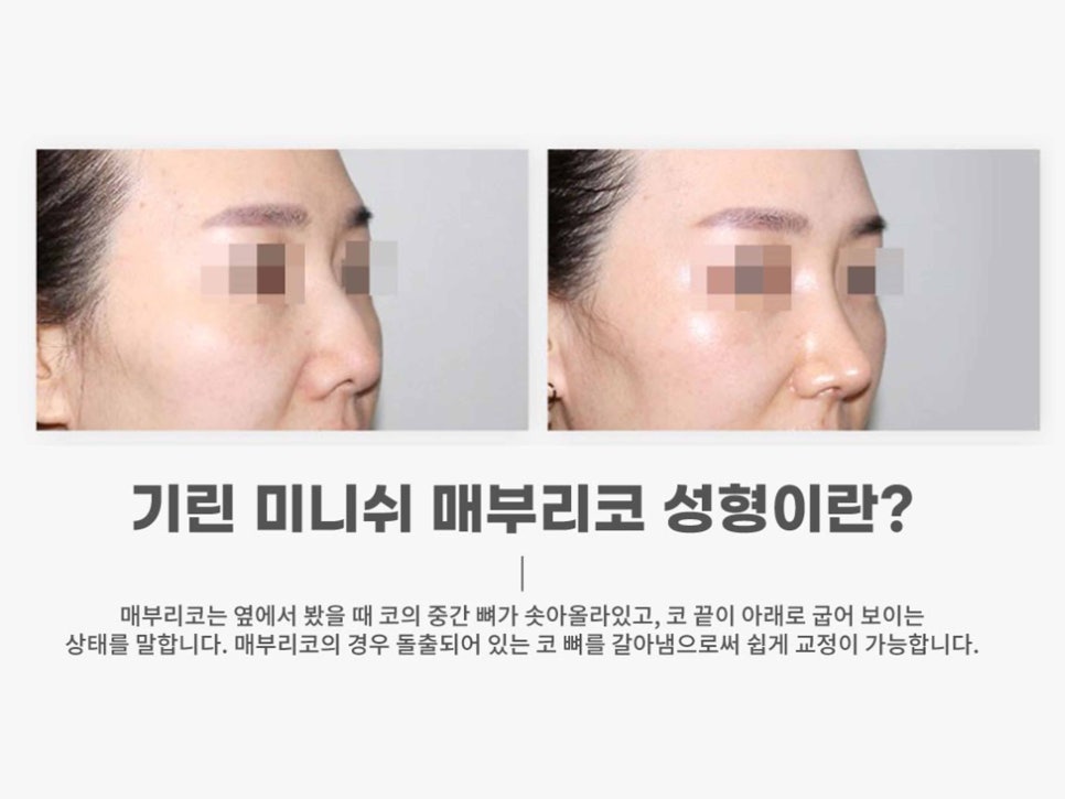 강남역성형외과유명한곳 얼굴에 맞춰 조화롭게 관련 이미지 13