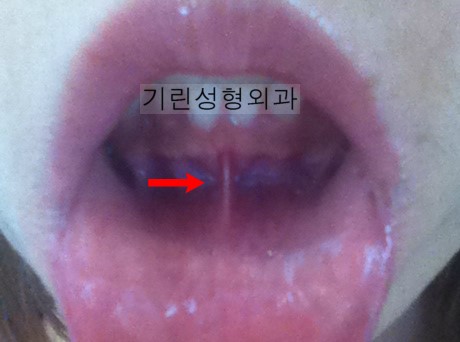 안면윤곽 후 순소대가 사라졌는데 부작용인가요? 관련 이미지 1