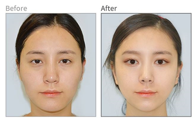 안면윤곽후기? 사실 도움 안 되는 이유 관련 이미지 3