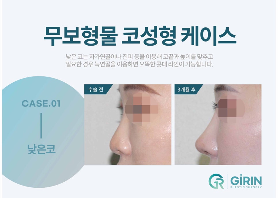 낮은코수술 눈에 보이는 차이를 원한다면 관련 이미지 5