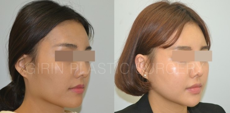 브이라인, 광대고정술 5개월경과 관련 이미지 2