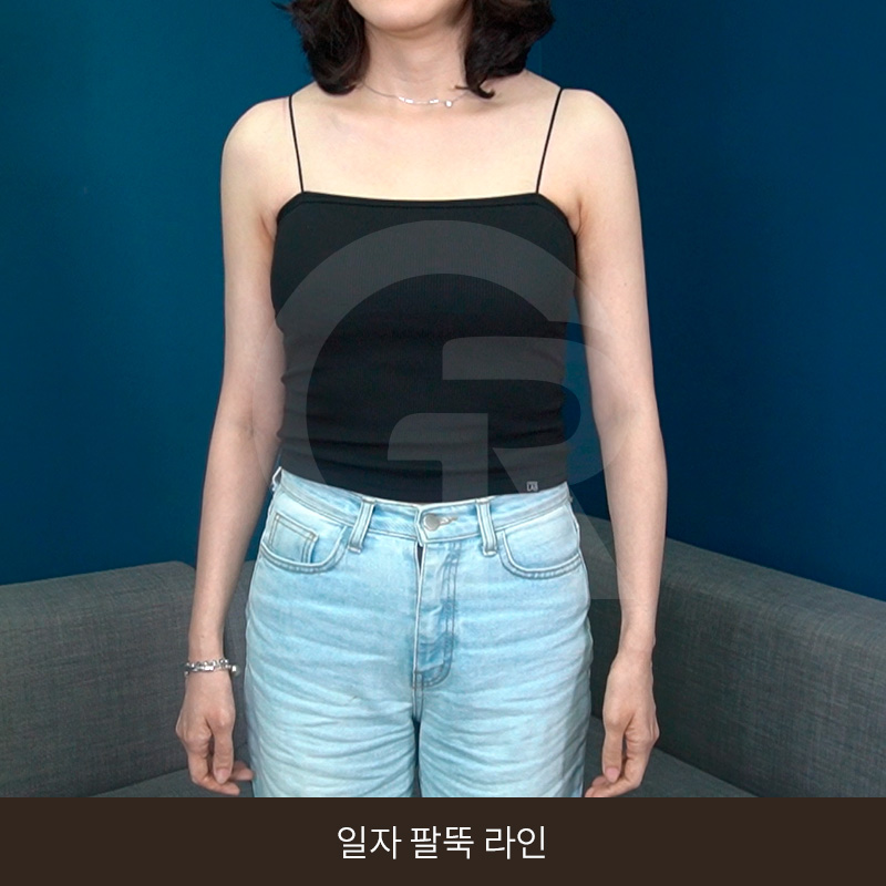 요가로 소용없던 굵은 팔뚝 지방흡입 수술 후기 관련 이미지 13