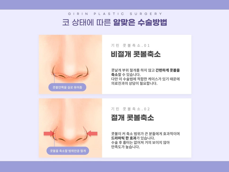 비절개콧볼축소수술 자연스럽고 예쁜 코 만들기 관련 이미지 4