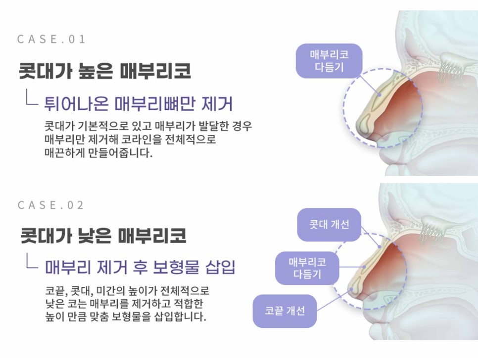 강남역성형외과유명한곳 얼굴에 맞춰 조화롭게 관련 이미지 11