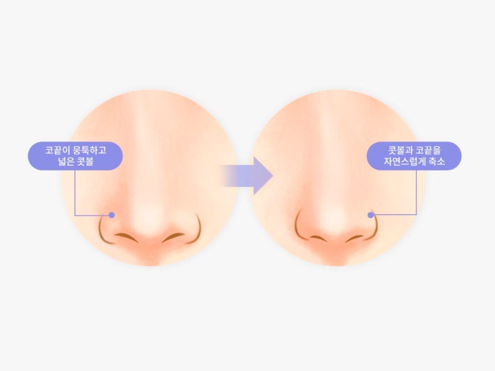콧볼축소수술전후 얼마나 달라질까 관련 이미지 3