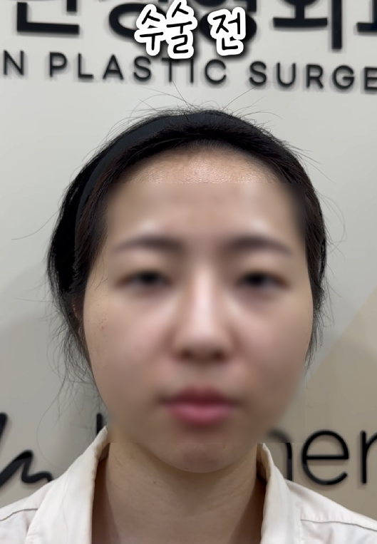 강남역 근처 쌍꺼풀 잘하는 곳 어디? 생생한 후기 관련 이미지 7