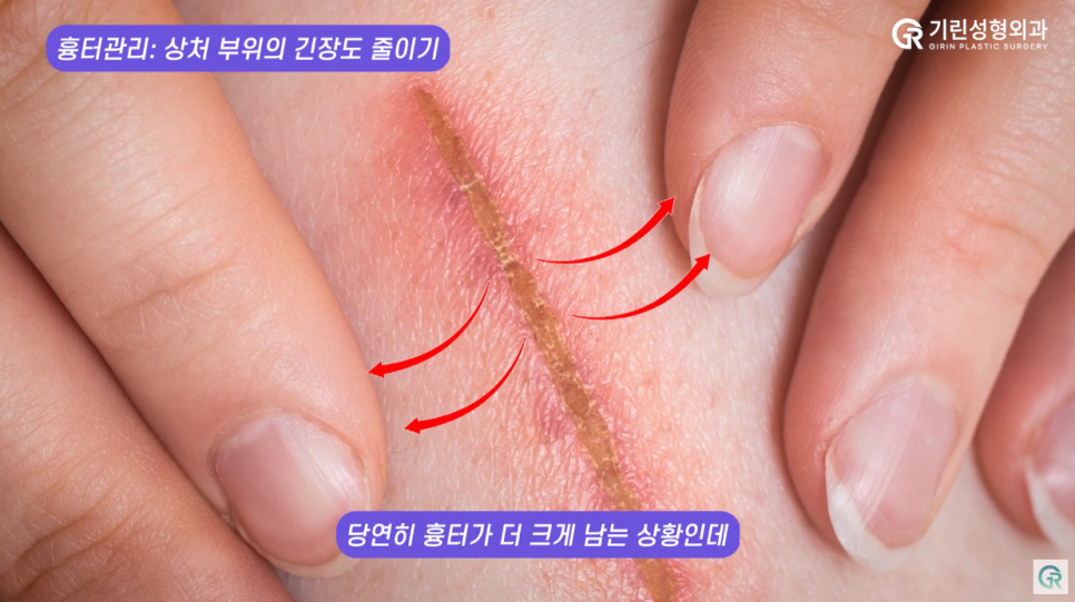 [기린성형외과] 겨울은 지방흡입의 계절_지방흡입 흉터관리 및 사후관리 관련 이미지 7