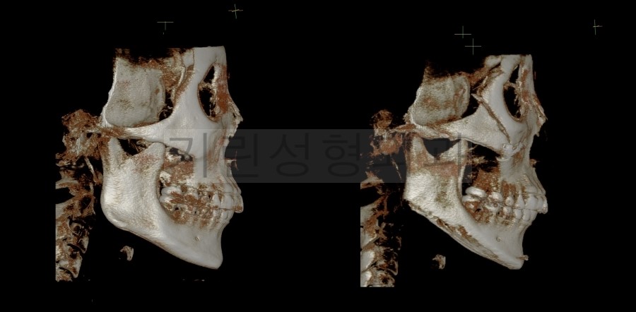 사각턱+앞턱+광대고정술 CASE 관련 이미지 5