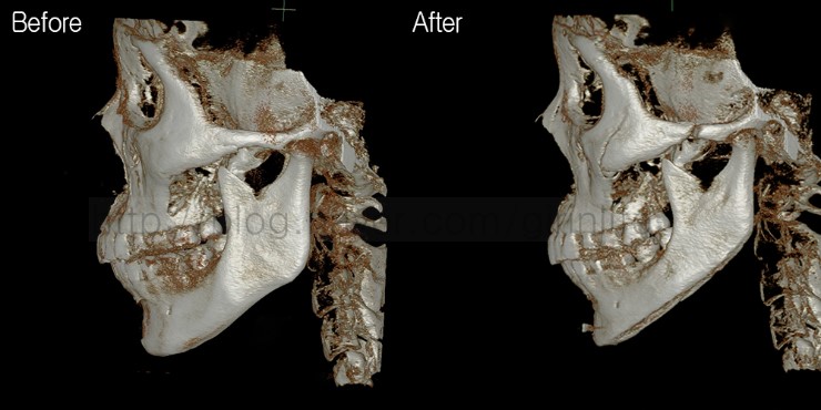 긴곡선절골로 앞턱길이를 함께 줄인 경우 관련 이미지 3