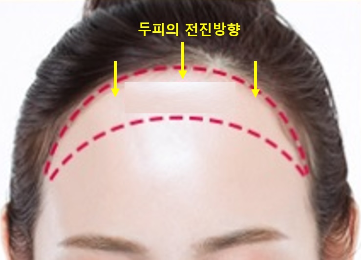 [공유] 이마축소술! 어떤 과정으로 수술하는지 알려드립니다 (안심하세요!) <<수술과정 大해부>> 관련 이미지 9