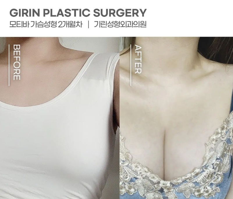 가슴성형외과유명한곳 확실하게 알아보고 관련 이미지 3
