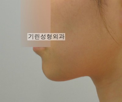 앞턱절골 관련 이미지 2